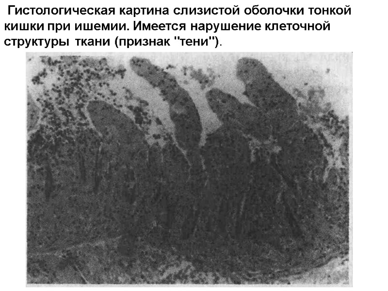 Гистологическая картина слизистой оболочки тонкой кишки при ишемии. Имеется нарушение клеточной структуры ткани (признак